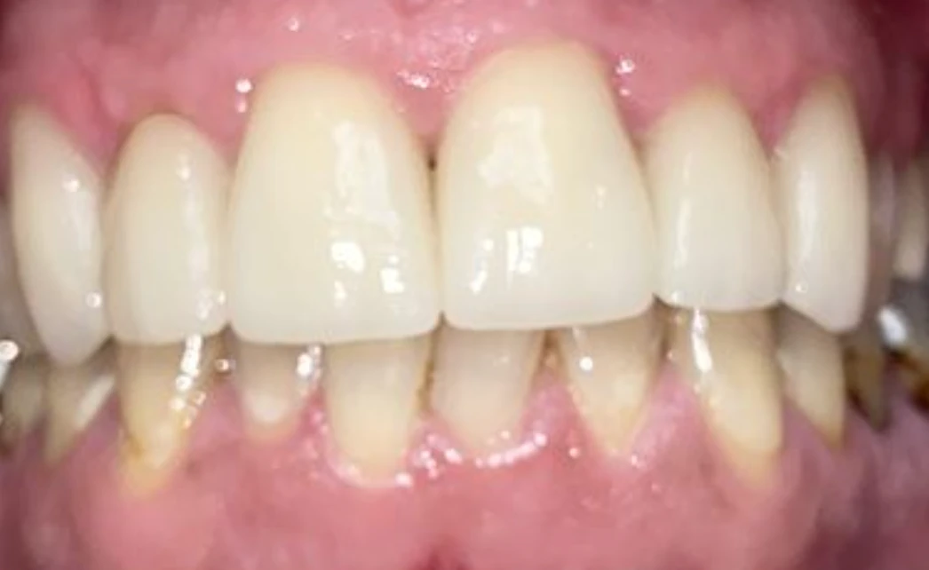 Full Mouth Restoration — after